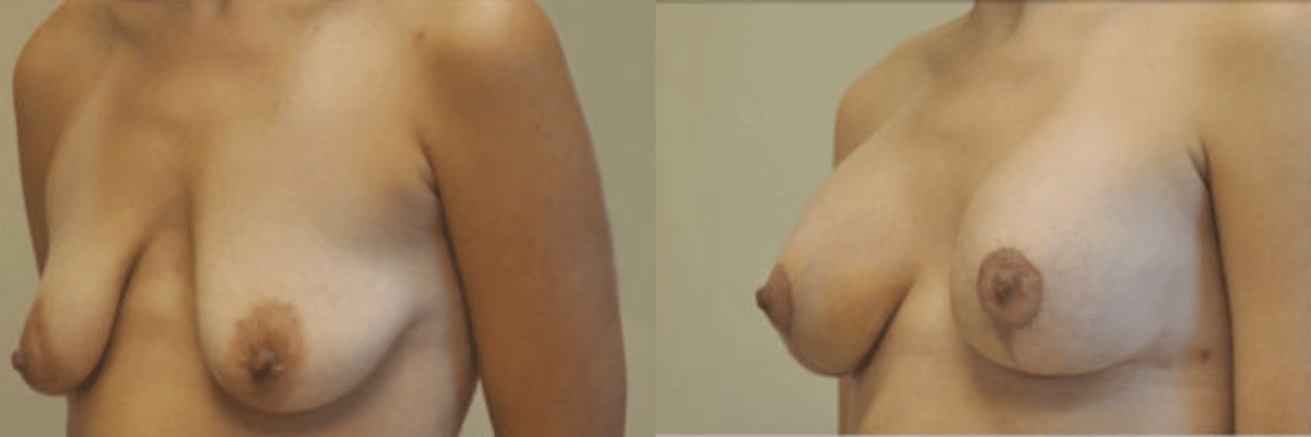 32 year old female before and after breast lift and augmentation silicone gel implant side view