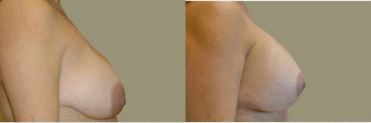38 year old female before and after breast lift and augmentation silicone gel implant side view