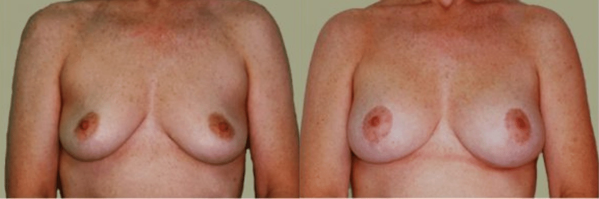 42 year old female before and after breast lift and augmentation silicone gel implant front view