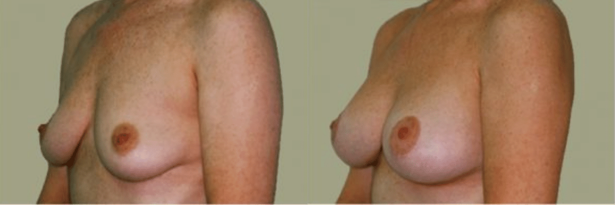42 year old female before and after breast lift and augmentation silicone gel implant side view