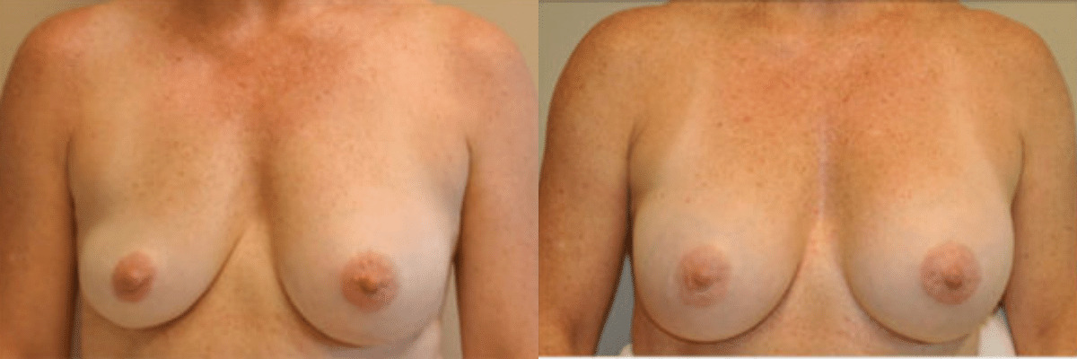 Breast Revision to correct deflation of implants 40 year old female front view