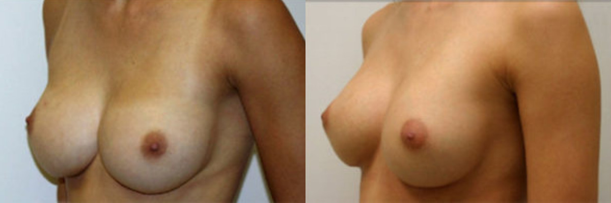 47 year old female breast revision to correct implant displacement before and after
