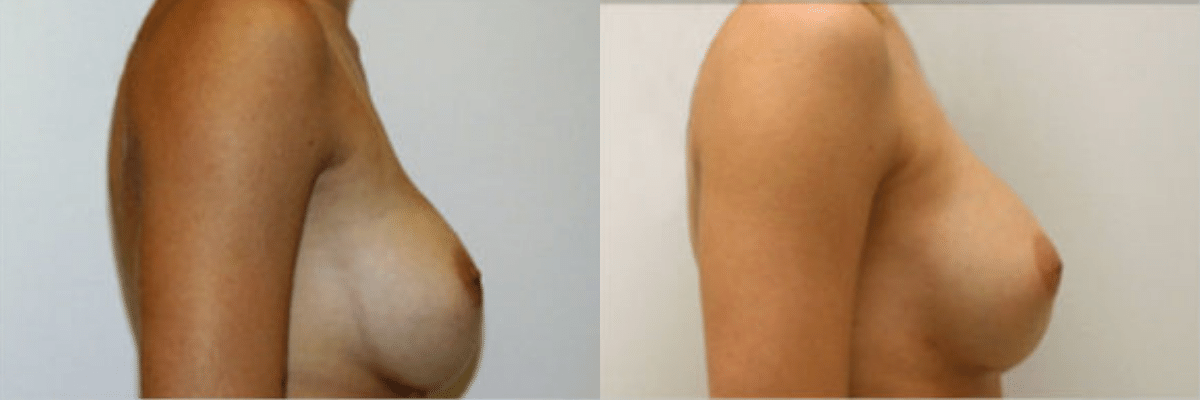 47 year old female breast revision to correct implant displacement before and after side view