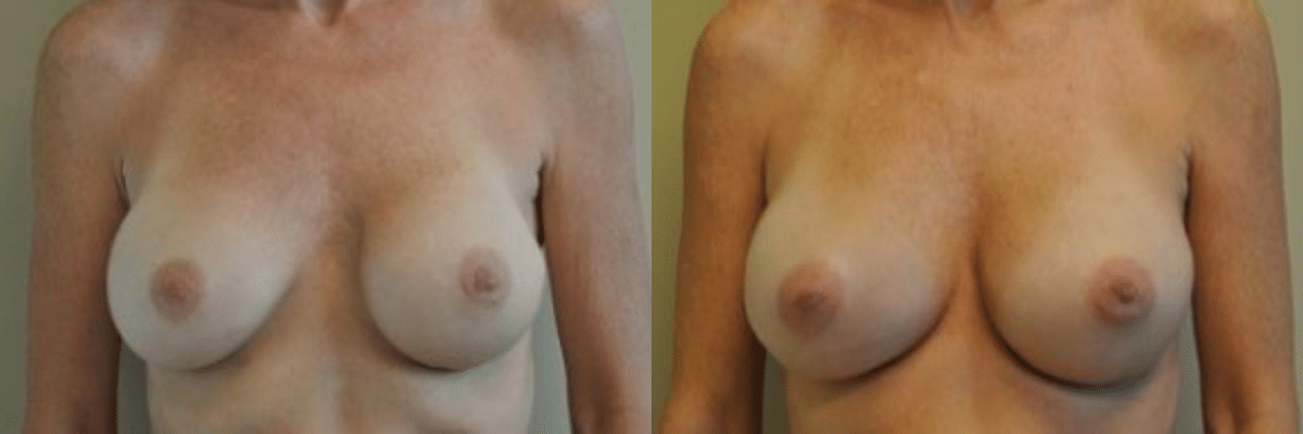 49 year old female breast revision to correct implant deflation before and after front view