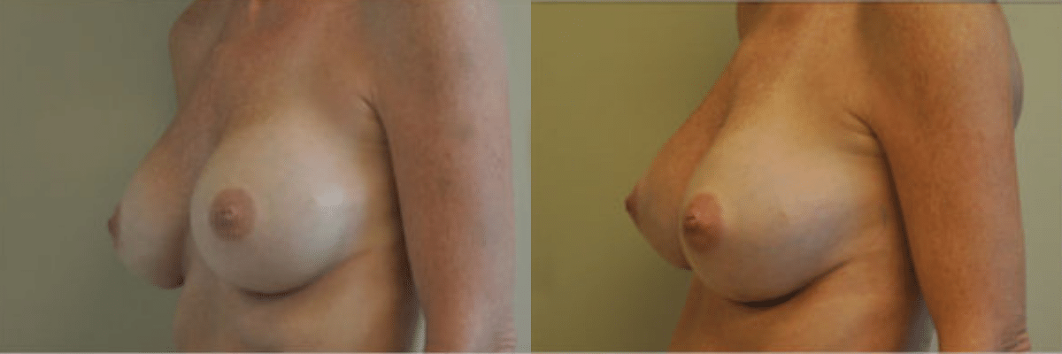 49 year old female breast revision to correct implant deflation before and after side view