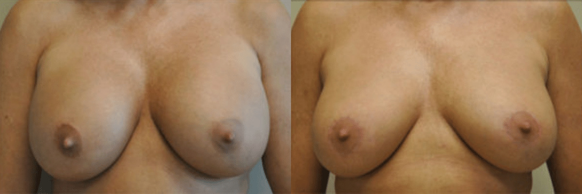 44 year old female breast revision to correct implant displacement before and after front view