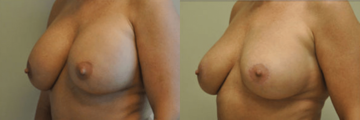 44 year old female breast revision to correct implant displacement before and after side view