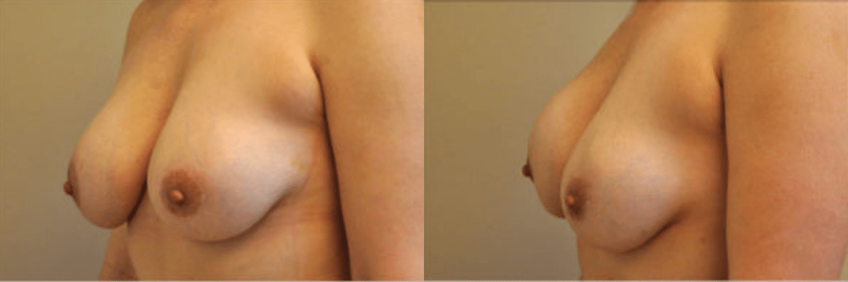 42 year old female patient breast revision developed hardening and displacement of the right breast implant (capsular contracture)side view
