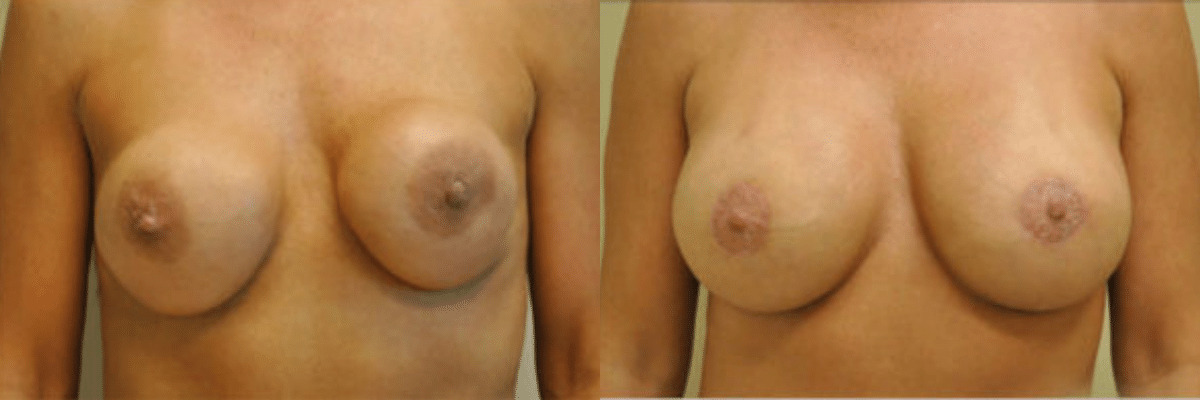 43 year old breast revision for severe asymmetry with capsular contracture, breast hardening before and after front view