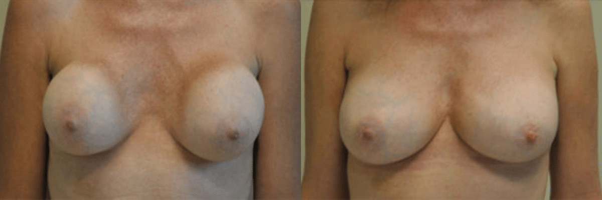 49 year old female capsular contracture surgery before and after front view