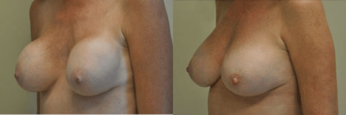 49 year old female capsular contracture surgery before and after