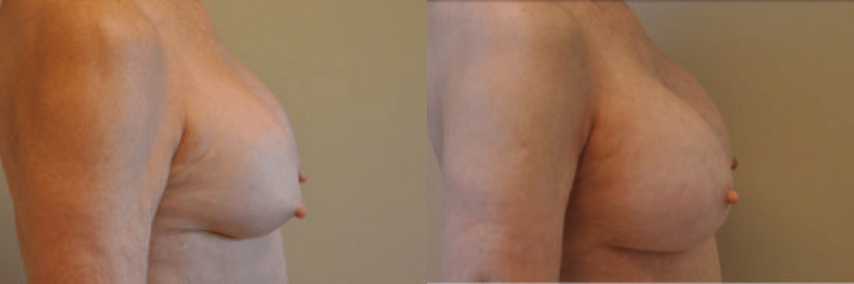 63 year old female capsular contracture surgery before and after side view
