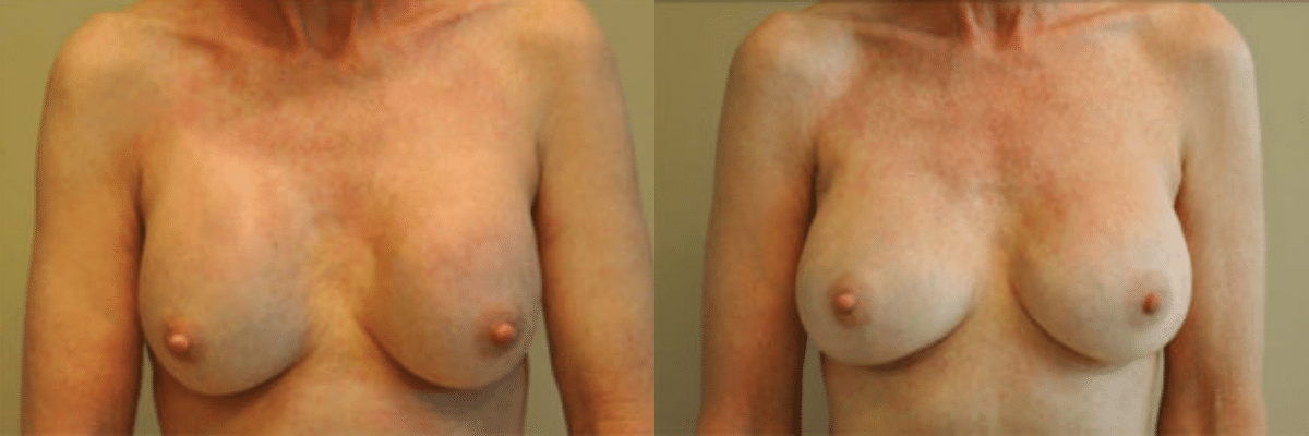 49 year old female before and after capsular contracture, replaced with 304cc gel implants front view