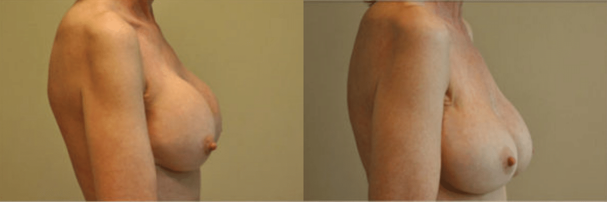49 year old female before and after capsular contracture, replaced with 304cc gel implants side view