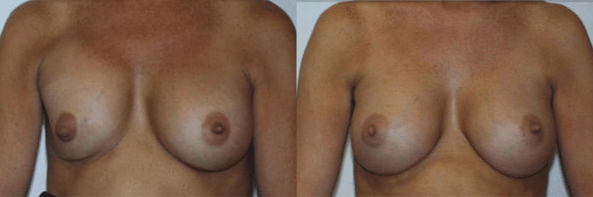28 year old female before and after breast revision surgery to repair capsular contracture front view