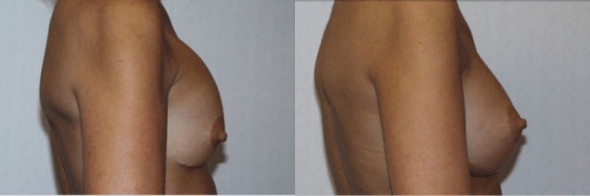 28 year old female before and after breast revision surgery to repair capsular contracture side view