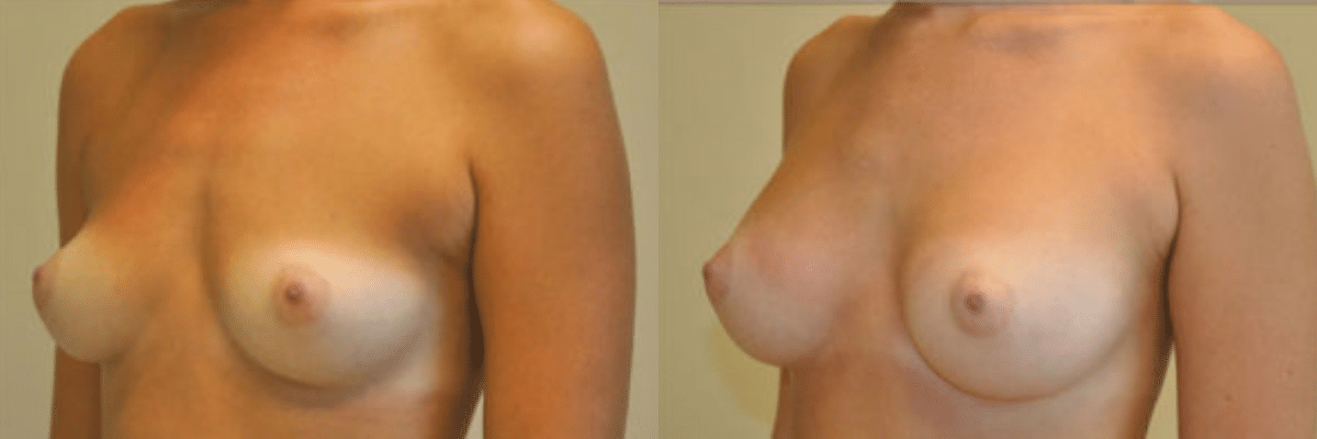 19 year old female before and after 250cc implant breast augmentation side view