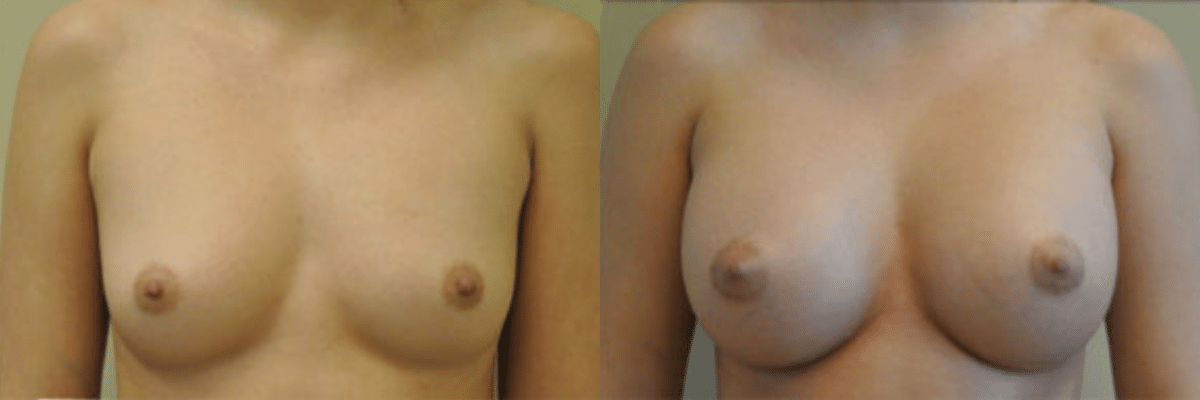 22 year old female before and after 339cc gel implant breast augmentation front view