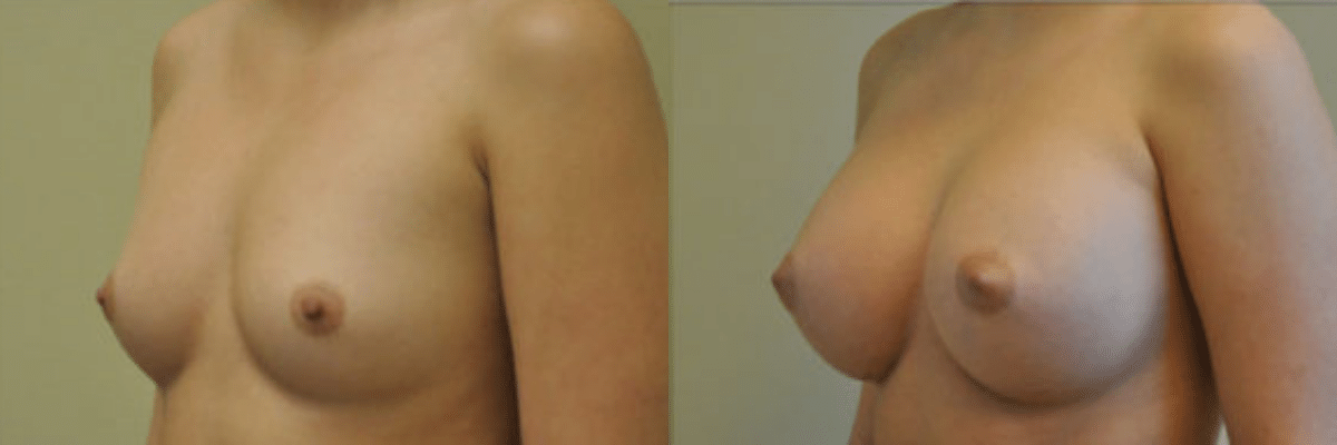 22 year old female before and after 339cc gel implant breast augmentation side view