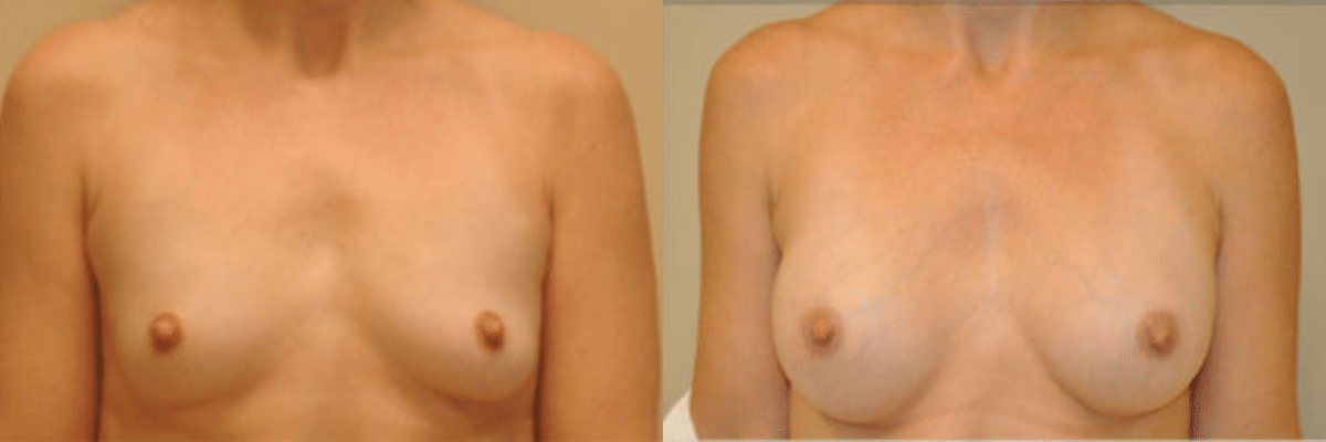 36 year old female before and after 265cc gel implant breast augmentation front view