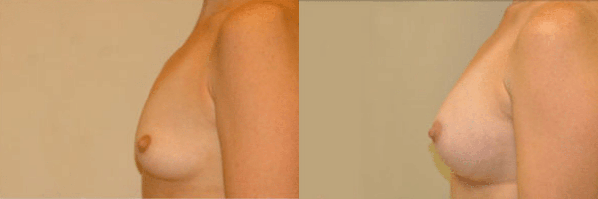 36 year old female before and after 265cc gel implant breast augmentation side view