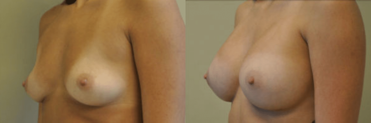 28 year old female before and after 397cc gel implant breast augmentation side view