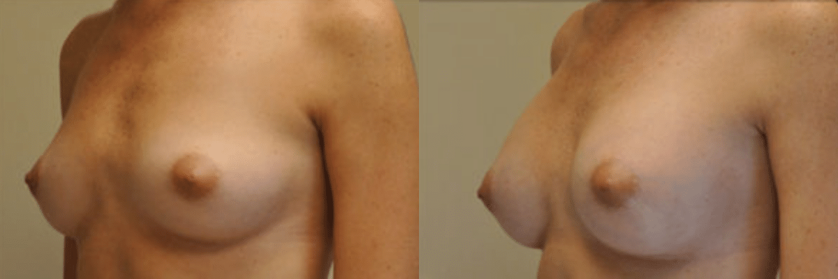 24 year old female before and after breast augmentation side view