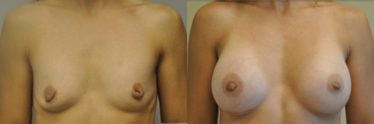41 year old female before and after 304cc gel implant breast augmentation front view
