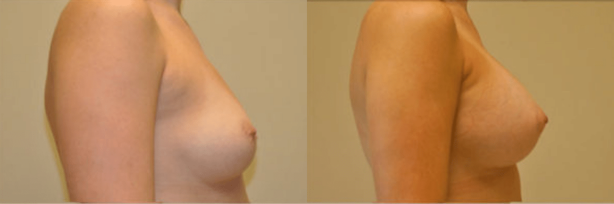 26 year old female before and after gel implant breast augmentation side view