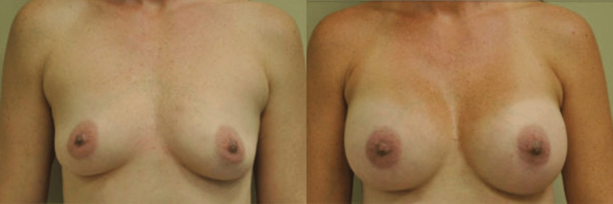 39 year old female before and after 421cc gel implant breast augmentation front view