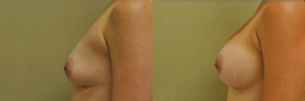 39 year old female before and after 421cc gel implant breast augmentation side view