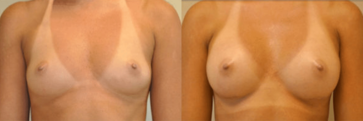 28 year old female before and after 304cc gel implant breast augmentation front view