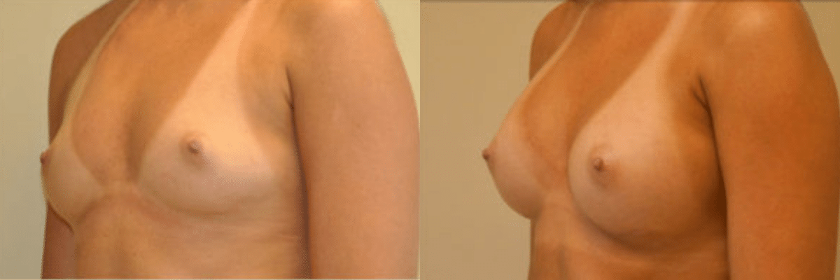 28 year old female before and after 304cc gel implant breast augmentation side view