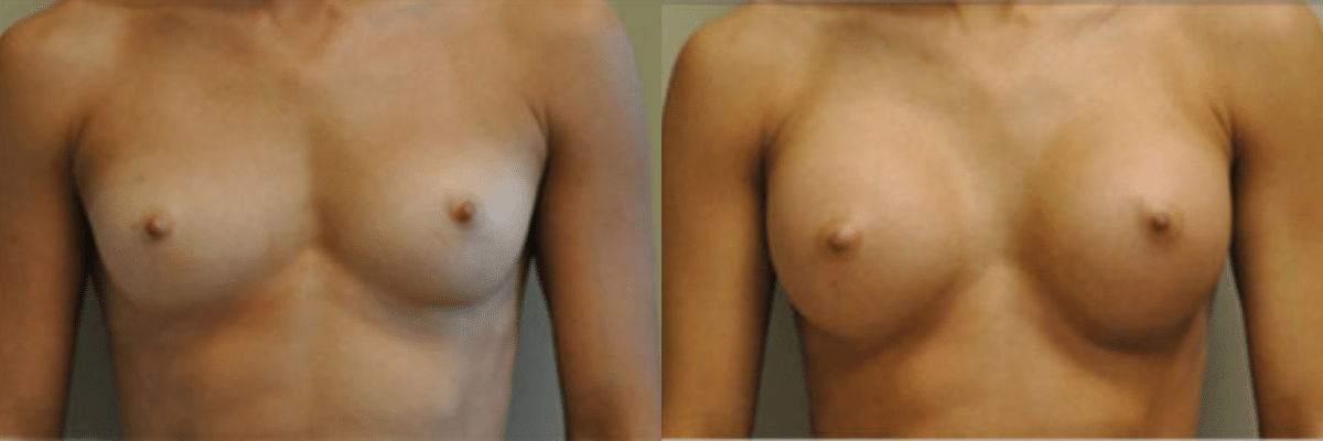 26 year old female before and after 304cc gel implant breast augmentation front view