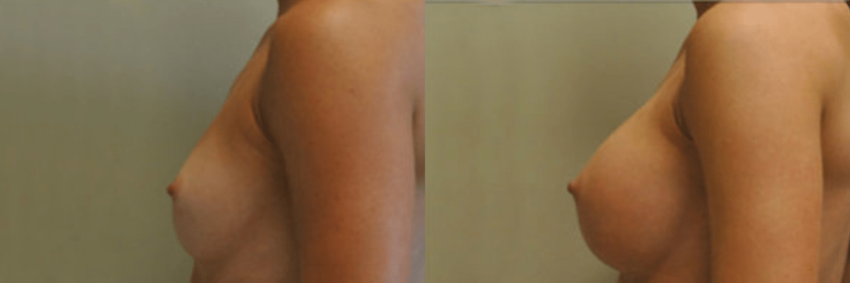 26 year old female before and after 304cc gel implant breast augmentation side view