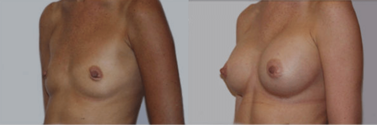 40 year old female before and after 300cc saline implant breast augmentation front view