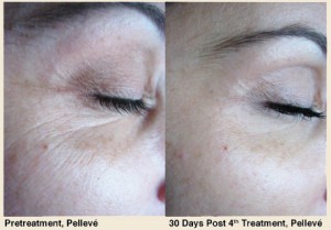 Pelleve eyes before and after treatment