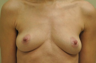 Breast Asymmetry Surgery - Before Photo