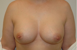 Breast Asymmetry Surgery Results