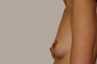 Breast Asymmetry Before Corrective Surgery
