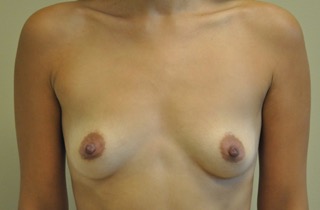Breast and Nipple Asymmetry Surgery - Before Photo