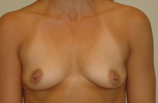 Nipple Asymmetry - Before Surgery Photo