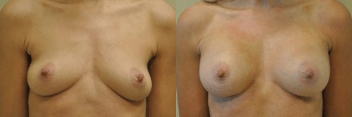 45 year old before and after breast asymmetry and augmentation surgery front view