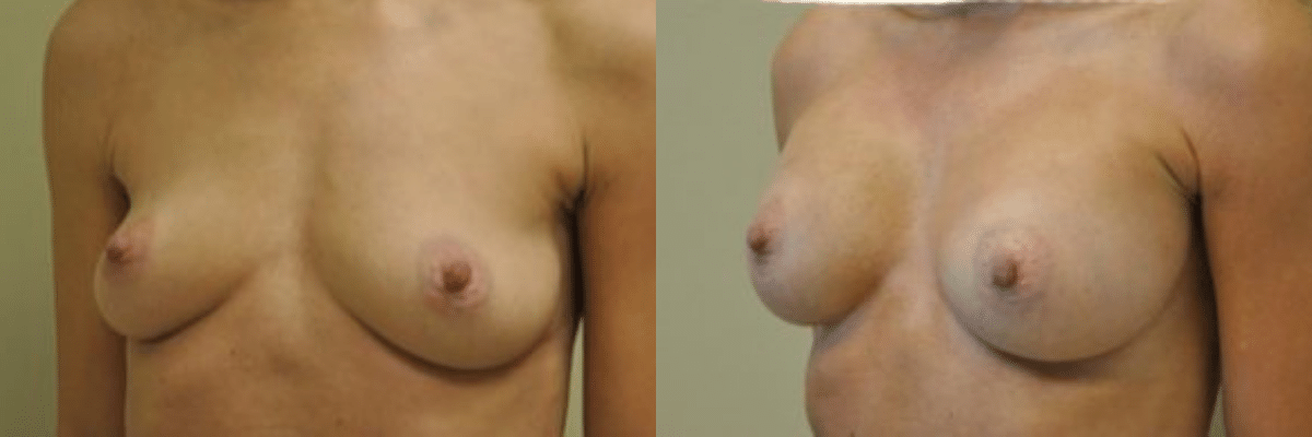 45 year old before and after breast asymmetry and augmentation surgery side view