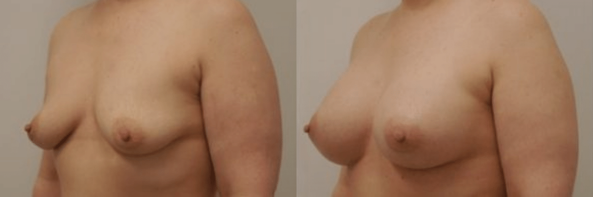 39 year old before and after breast asymmetry and augmentation surgery side view