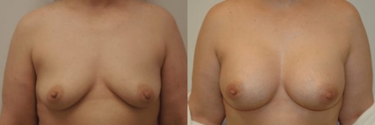 39 year old before and after breast asymmetry and augmentation surgery front view