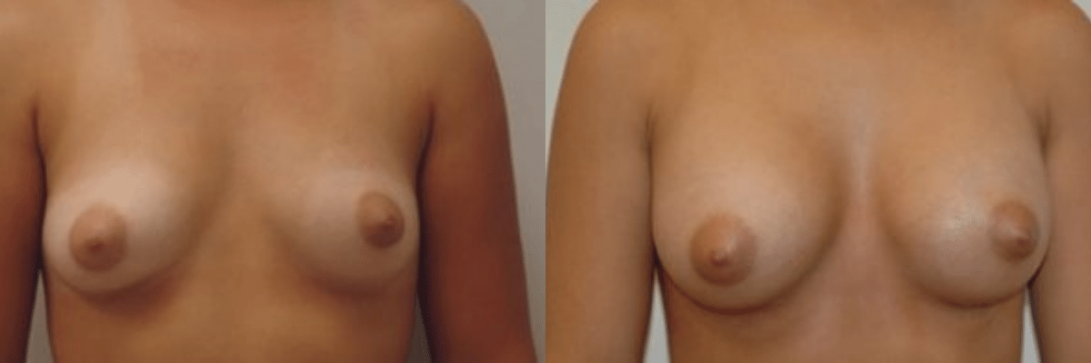 20 year old before and after breast asymmetry and augmentation surgery front view