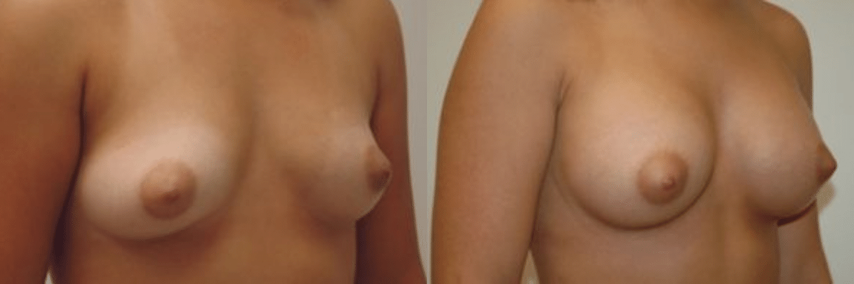 20 year old before and after breast asymmetry and augmentation surgery side view