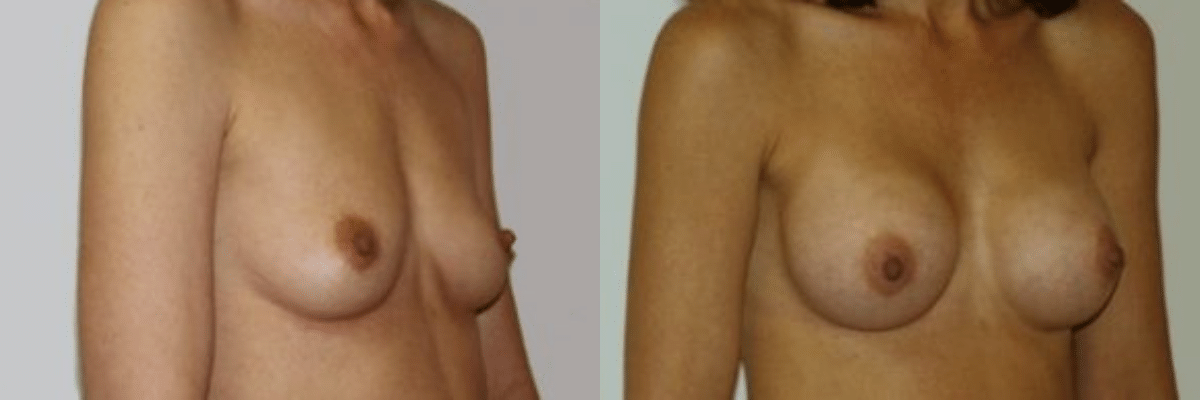 37 year old before and after breast asymmetry and augmentation surgery front view