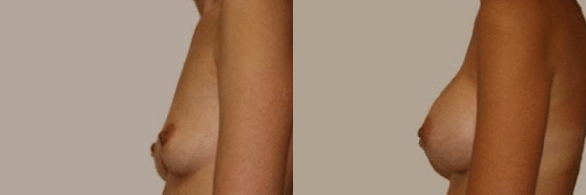 37 year old before and after breast asymmetry and augmentation surgery side view